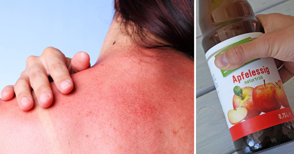 Sunburn Treatment: Best Natural Home Remedies