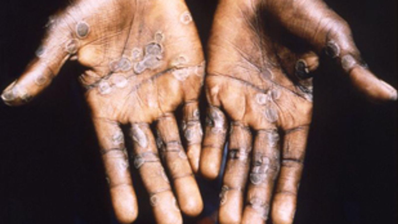 Two cases of monkeypox virus detected in Wales