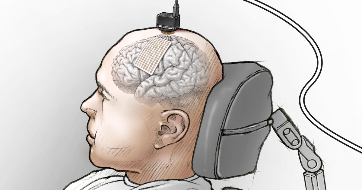 A brain implant turns thoughts into words to help a paralyzed person 'speak' again