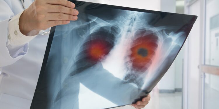 A doctor holds an x-ray of the lung in his hand.