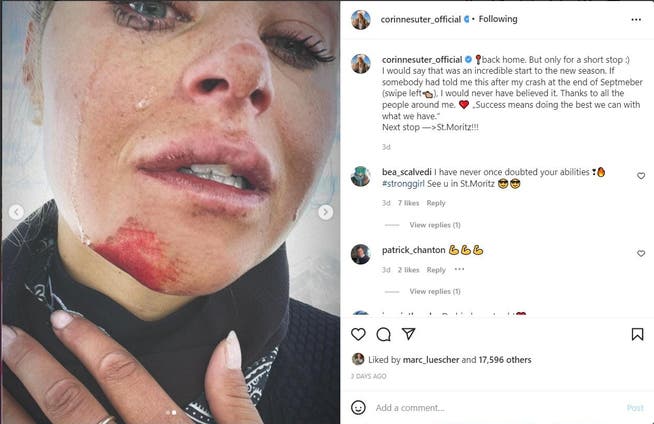 Corinne Sutter shows off her wounds on Instagram. 