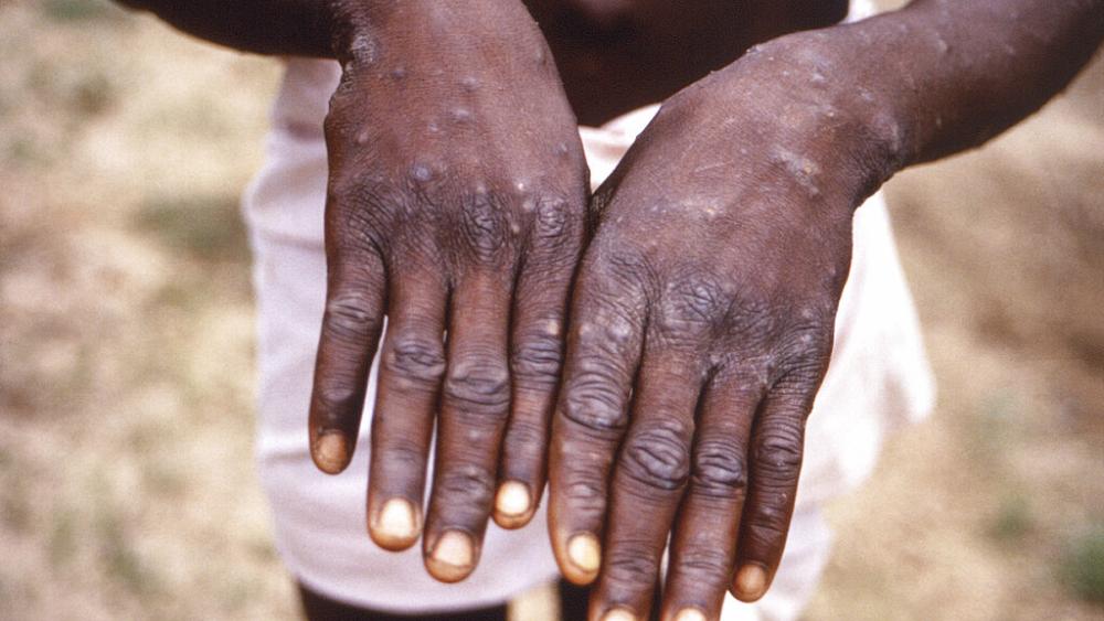 Monkey pox spreads: Great Britain, Spain and Portugal are particularly affected