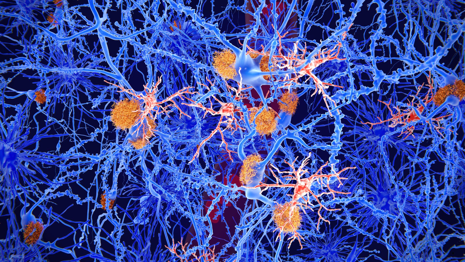 Alzheimer's disease: Plaques heat nerve cells