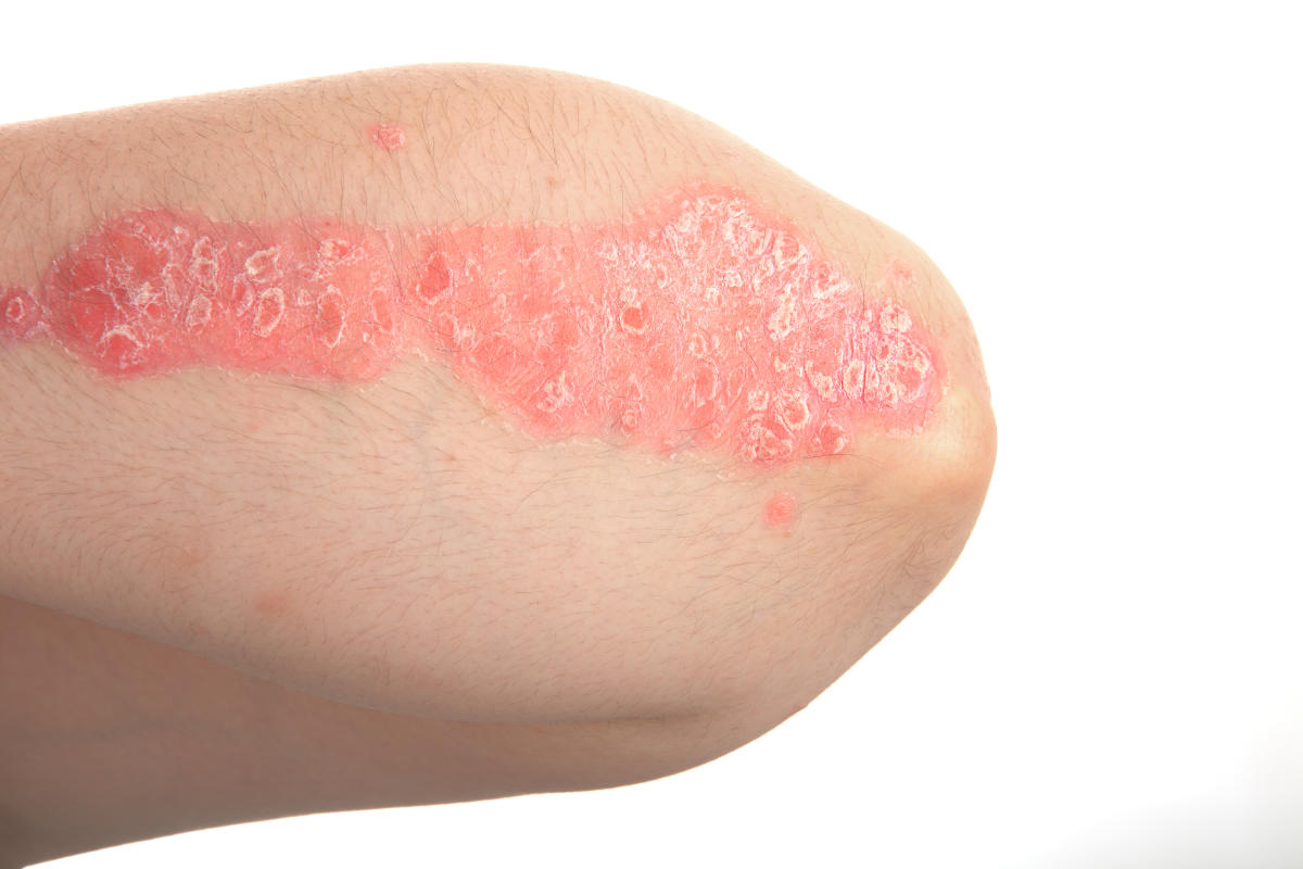 Six Important Facts About Common Skin Diseases